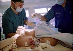Лос-Анджелесе проходит сложнейшая операция по разделению сиамских близнецов