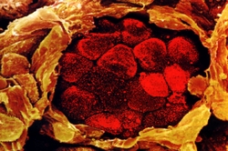 Найден механизм разрушения иммунитета организма раковыми клетками